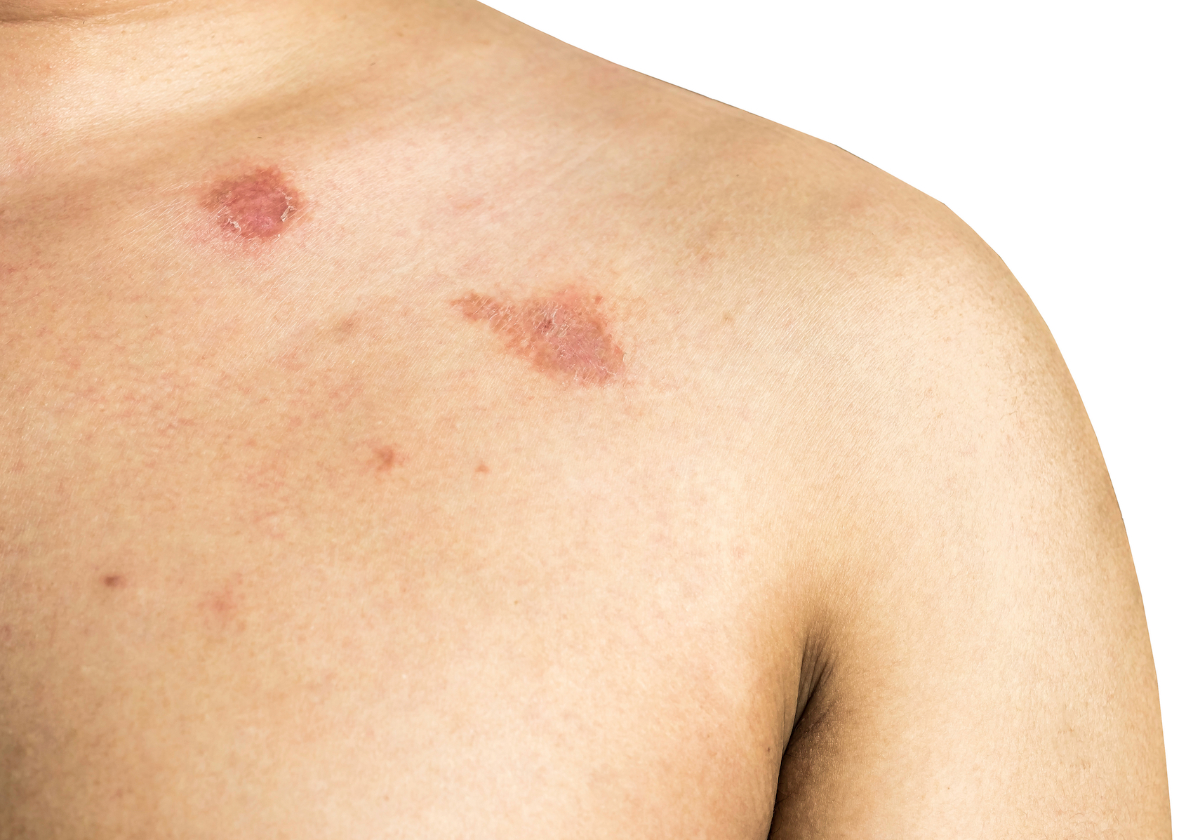Ringworm on the body. It is caused by a fungus isolated on white background.