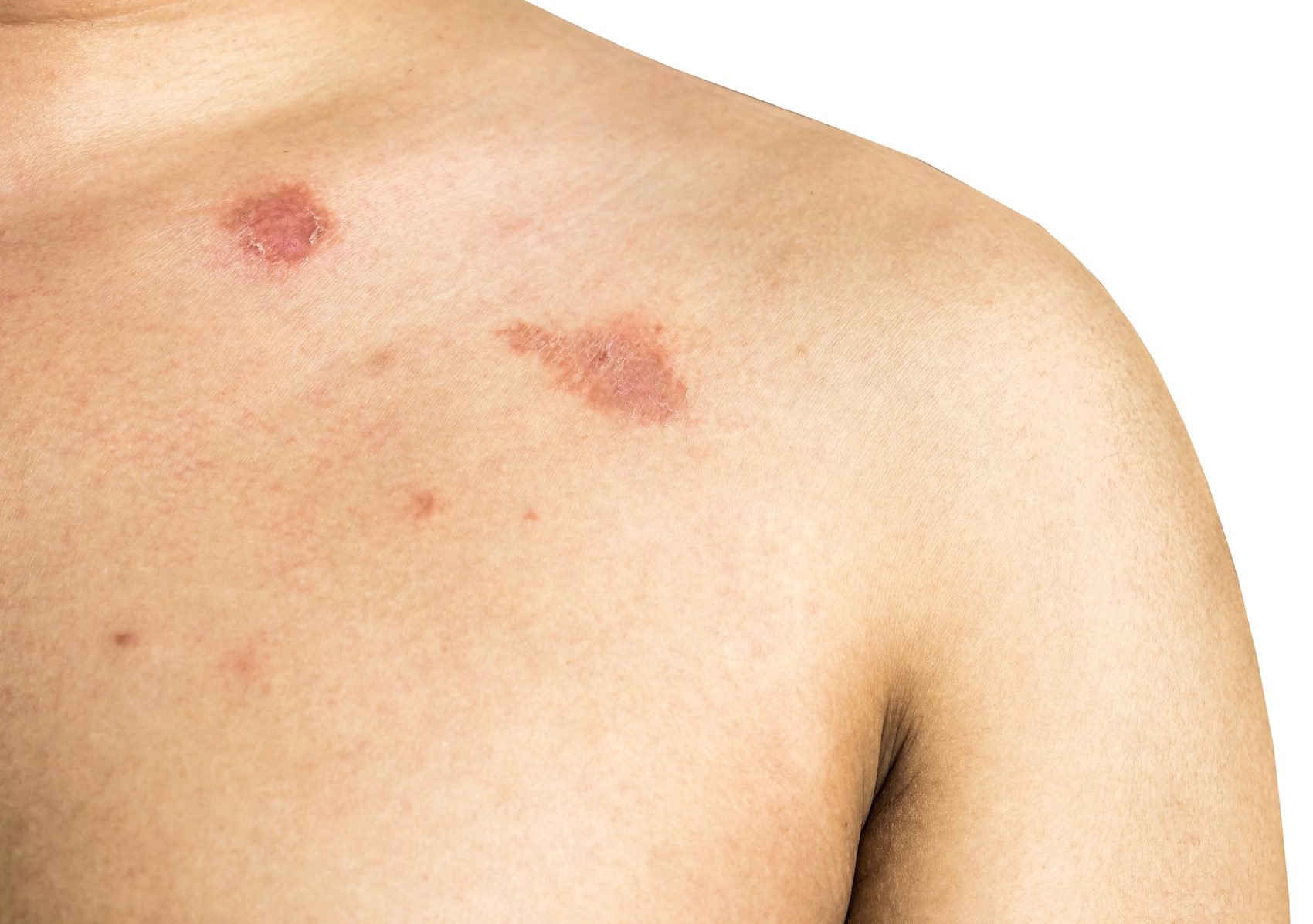 Ringworm,On,The,Body.,It,Is,Caused,By,A,Fungus Ringworm on the body. It is caused by a fungus isolated on white background.